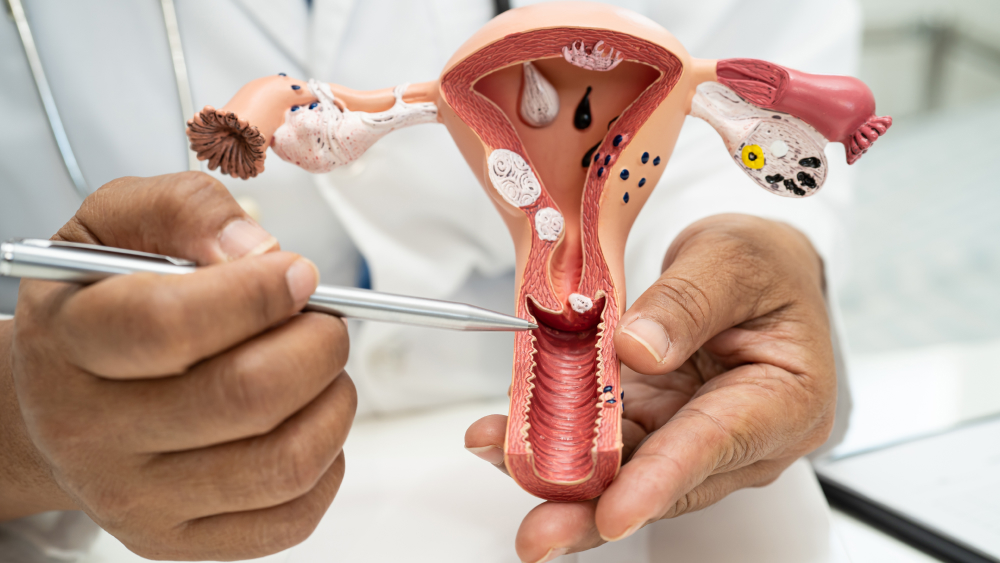 Laparoscopic Myomectomy: Preserving Fertility with Minimally Invasive Techniques