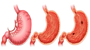 Stages of stomach ulcer formation showing healthy, inflamed, and ulcerated stomach.
