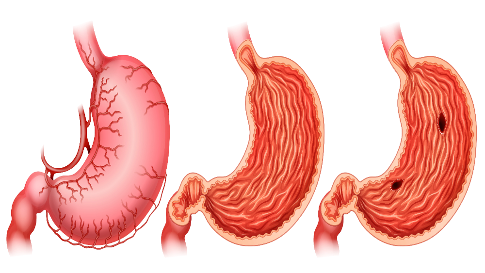 Stages of stomach ulcer formation showing healthy, inflamed, and ulcerated stomach.