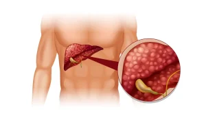 Gallbladder stones in liver illustration showing symptoms and when surgery is needed