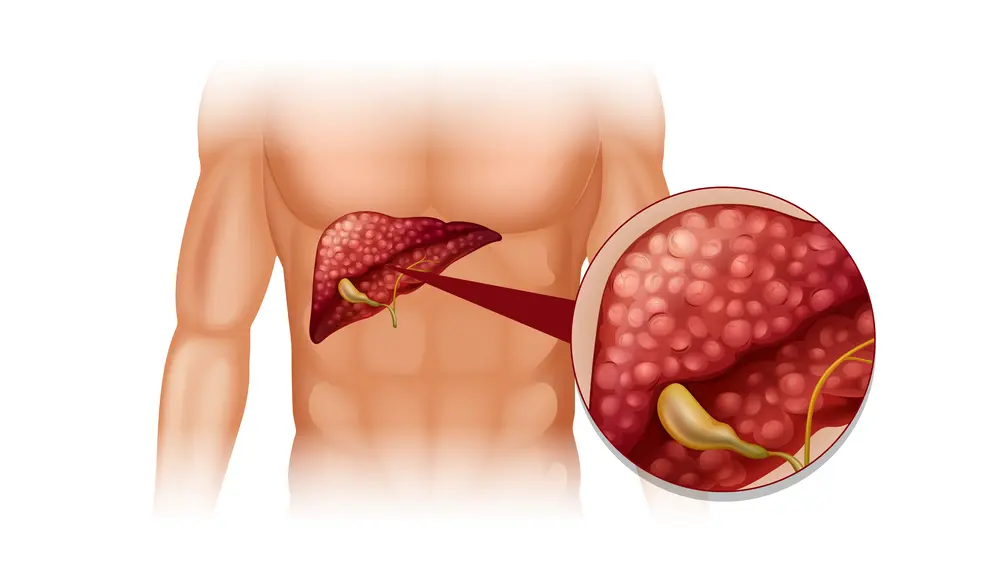 Gallbladder stones in liver illustration showing symptoms and when surgery is needed
