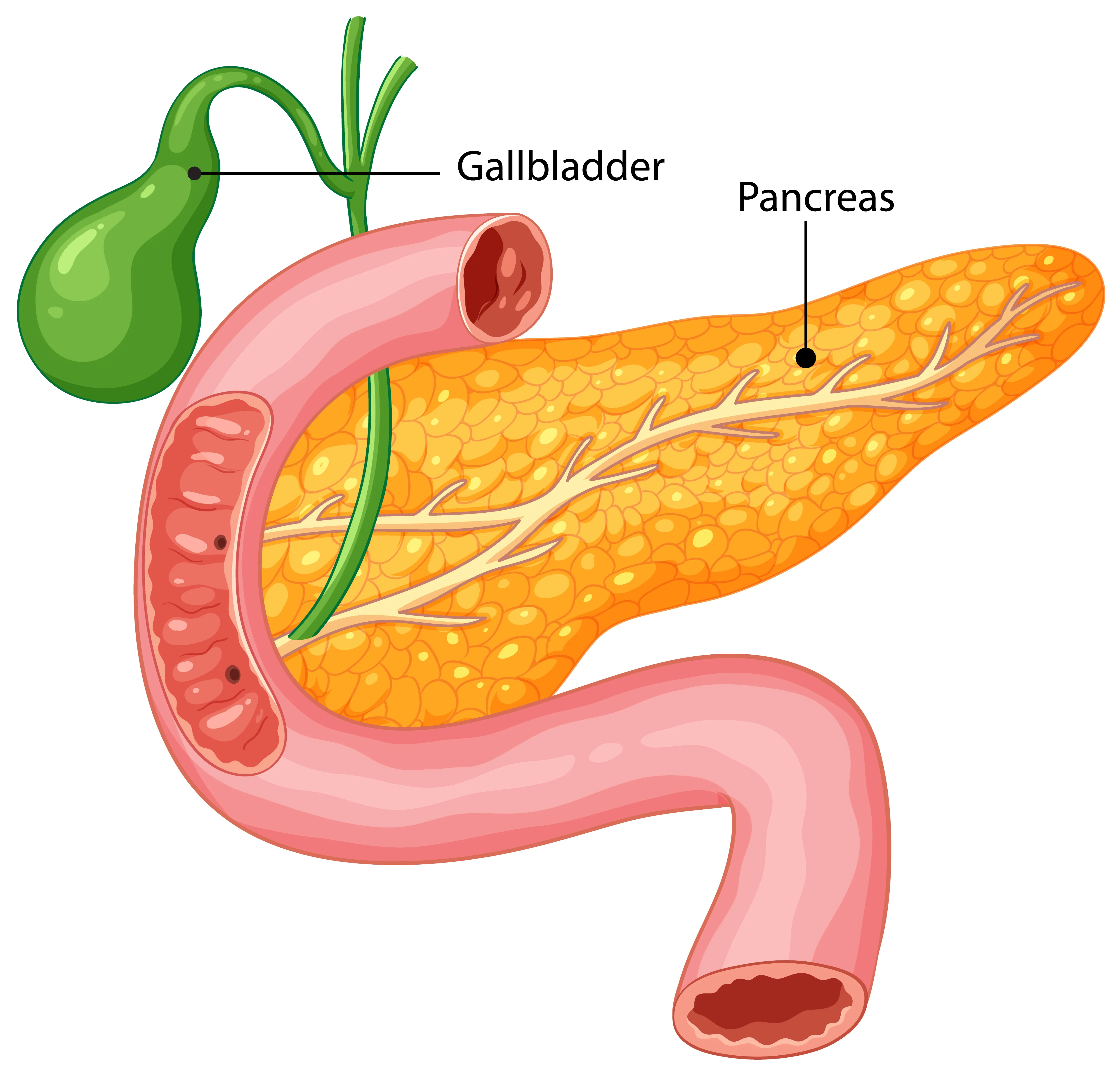 radical gastrectomy